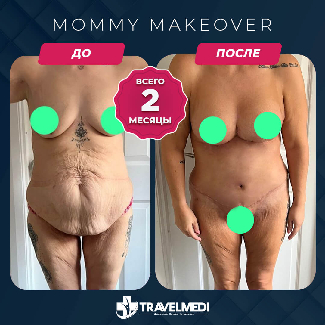 Результаты после Mommy Makeover в Турции Преображение мамы до и после в Турции