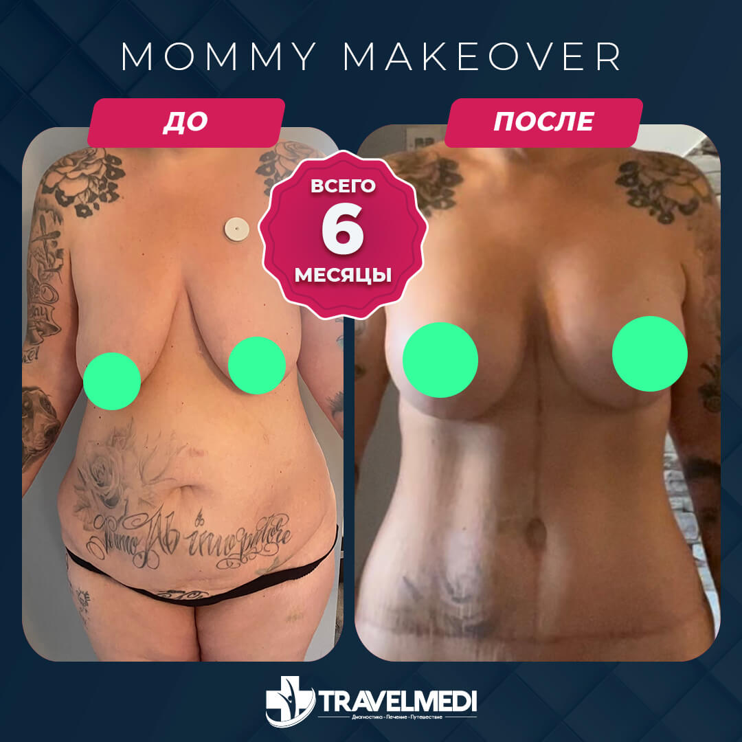 Результаты после Mommy Makeover в Турции Преображение мамы до и после в Турции