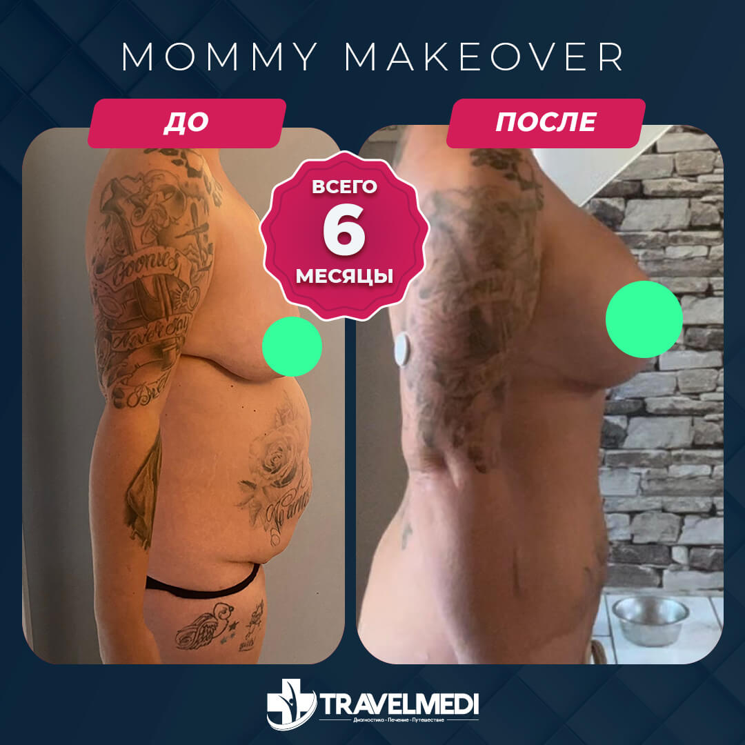Результаты после Mommy Makeover в Турции Преображение мамы до и после в Турции