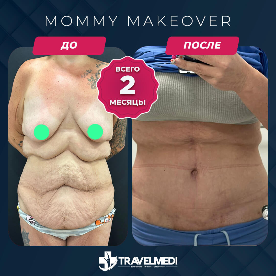 Результаты после Mommy Makeover в Турции Преображение мамы до и после в Турции