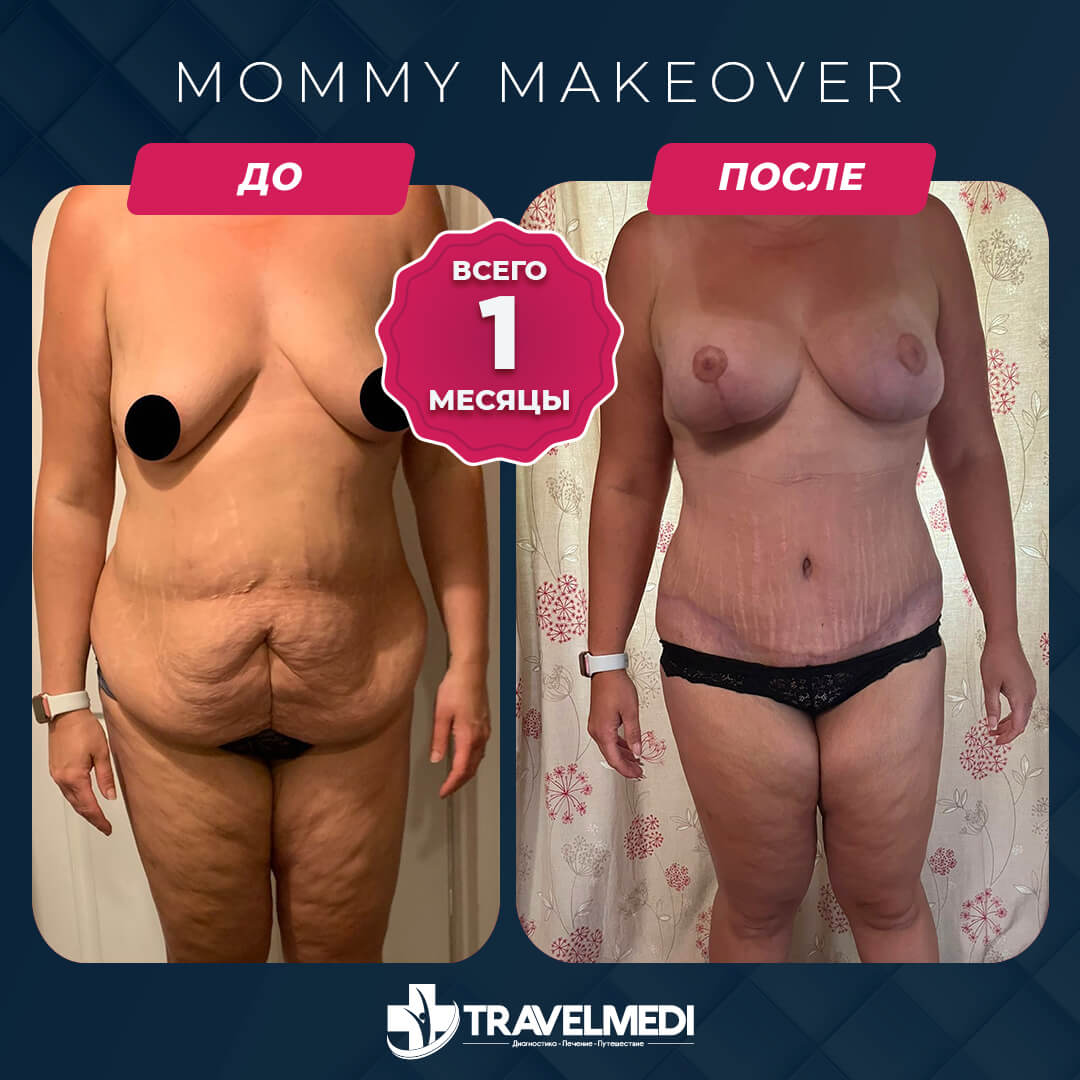 Результаты после Mommy Makeover в Турции Преображение мамы до и после в Турции