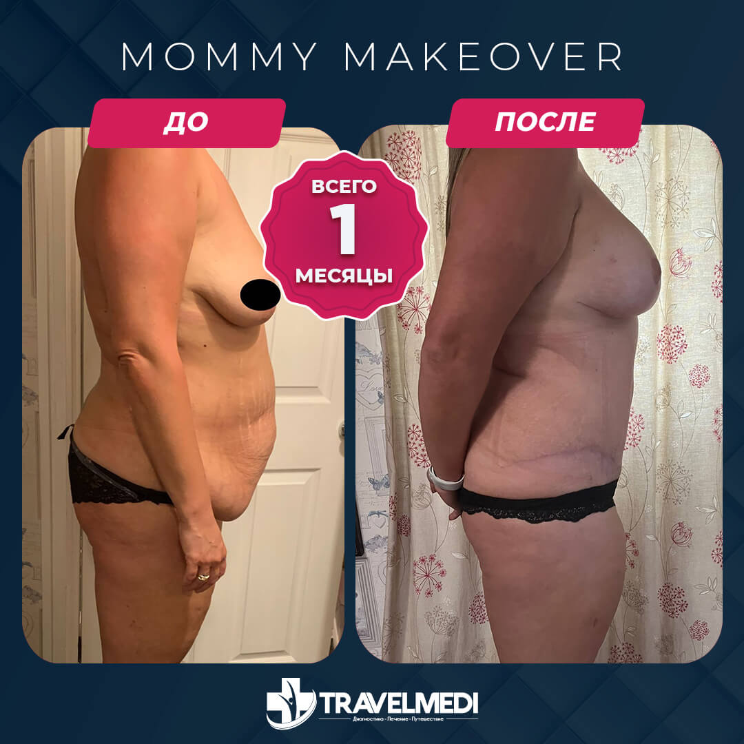 Результаты после Mommy Makeover в Турции Преображение мамы до и после в Турции